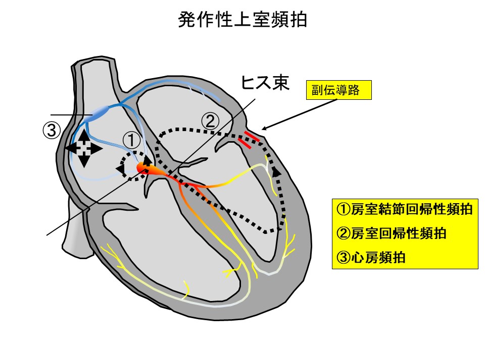  VTとSVTの違いは何ですか?