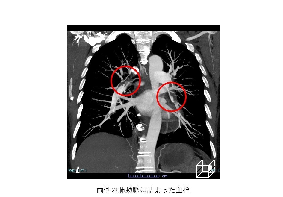 頸静脈血栓症の原因は何ですか?